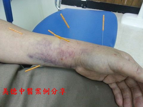 針灸與金黃散之臨床應用