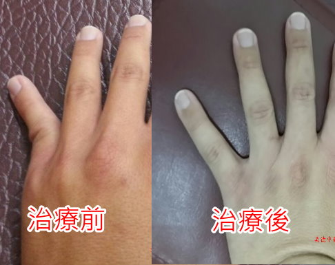 打籃球小指單純扭挫傷(吃蘿蔔乾)